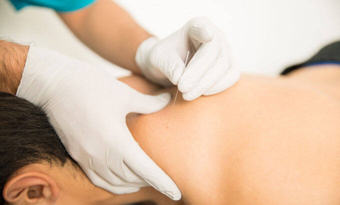 new-dry-needling dry needling St. Paul